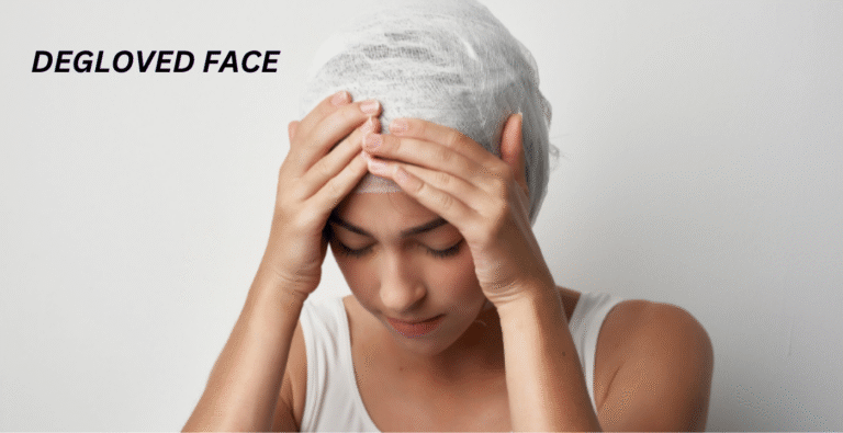 DEGLOVED FACE: Advances in Treating Its Long-Term Effects